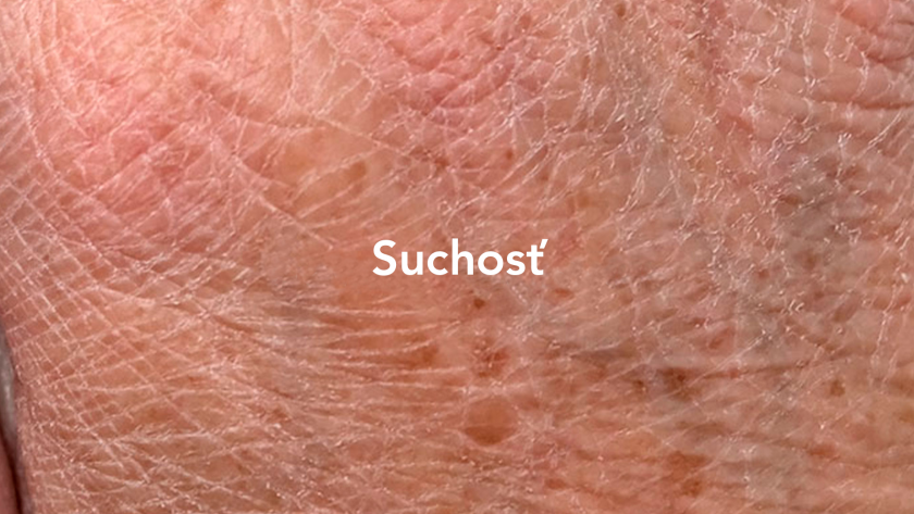 suchosť