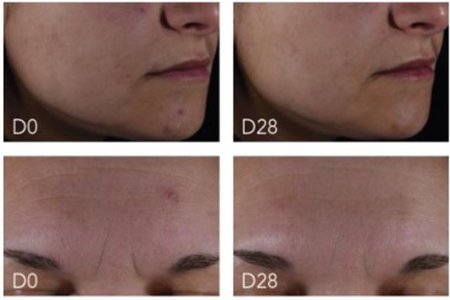 Transformative Results: Before and After Photos with Sébium Serum