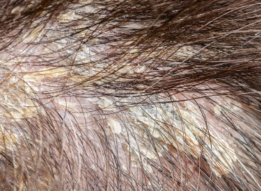 seboroická dermatitída na pokožke hlavy