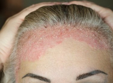 psoriasis on forehead and scalp